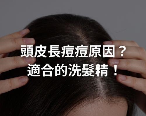 頭皮長痘痘原因？頭皮長痘痘推薦洗髮精！