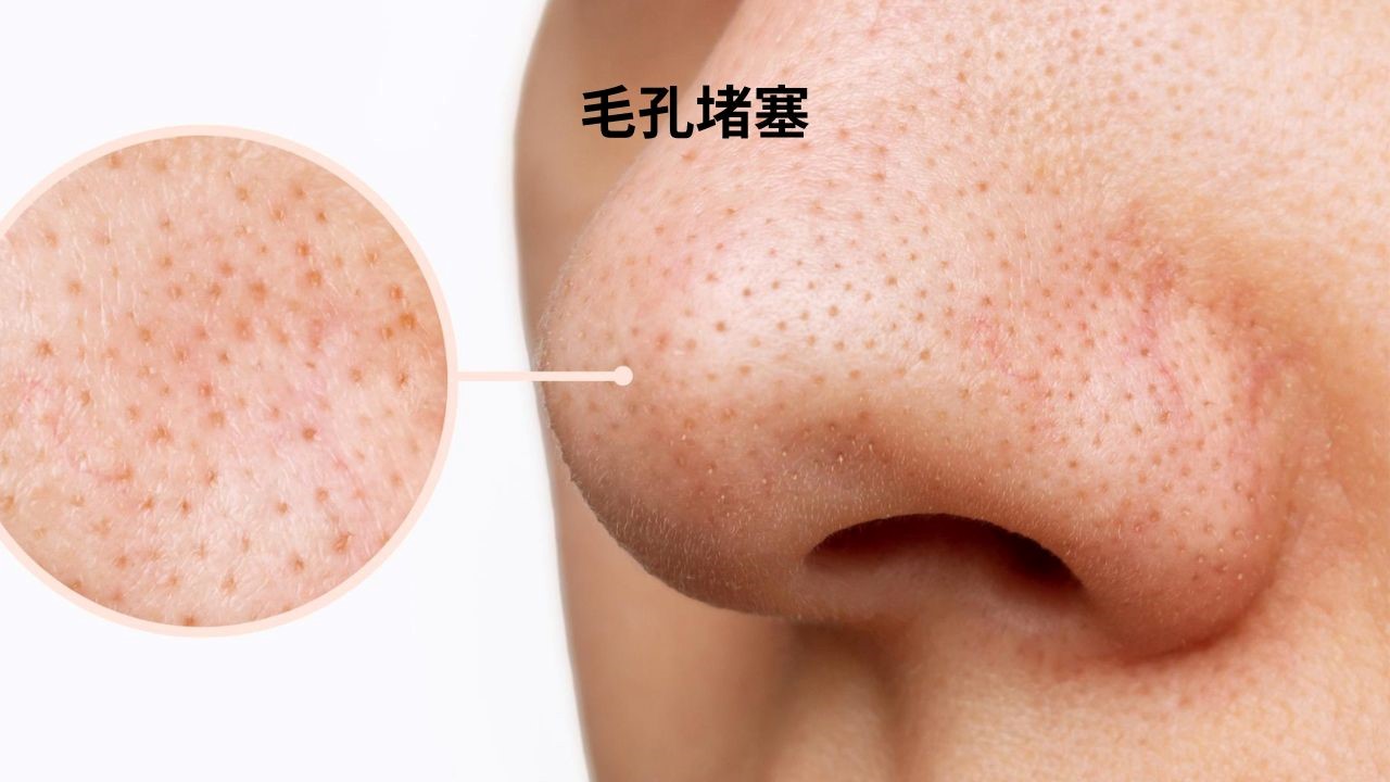 杜鵑花酸有什麼功效？水楊酸可以跟杜鵑花酸一起用嗎？