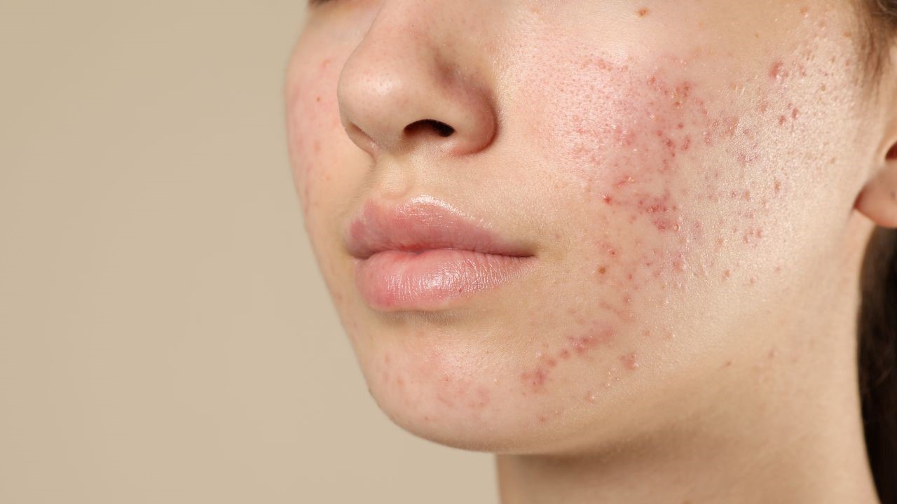 為什麼青春痘會變凹疤？如何不讓痘痘留疤？