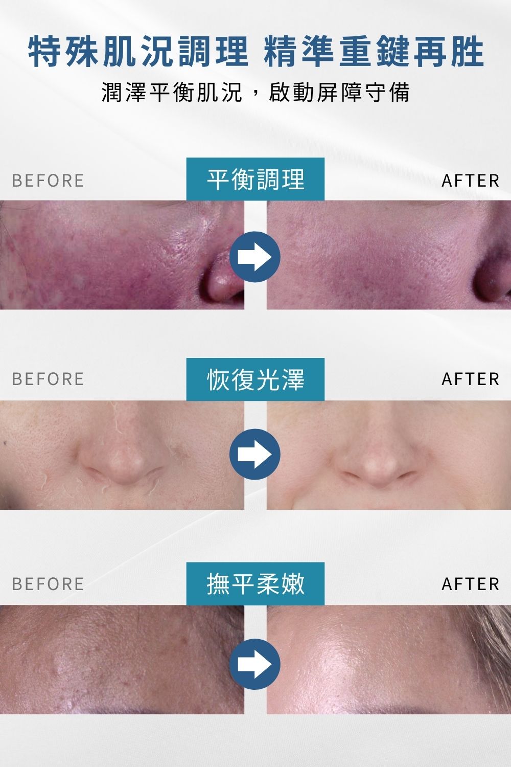 正值特殊或煥膚期間難以照顧膚況變化，修復耐受重建急需調理呵護，平衡肌況不可或缺的成分，溫和保養〈超酵A醛〉搭配〈退紅肌膚修護因子〉舒緩因肌膚乾燥引起的泛紅及深度保濕，適合所有特殊膚質。母親節限時7折搶購，限量50組！