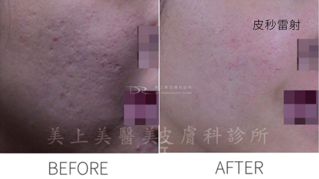 毛孔粗大原因？毛孔怎麼縮小？