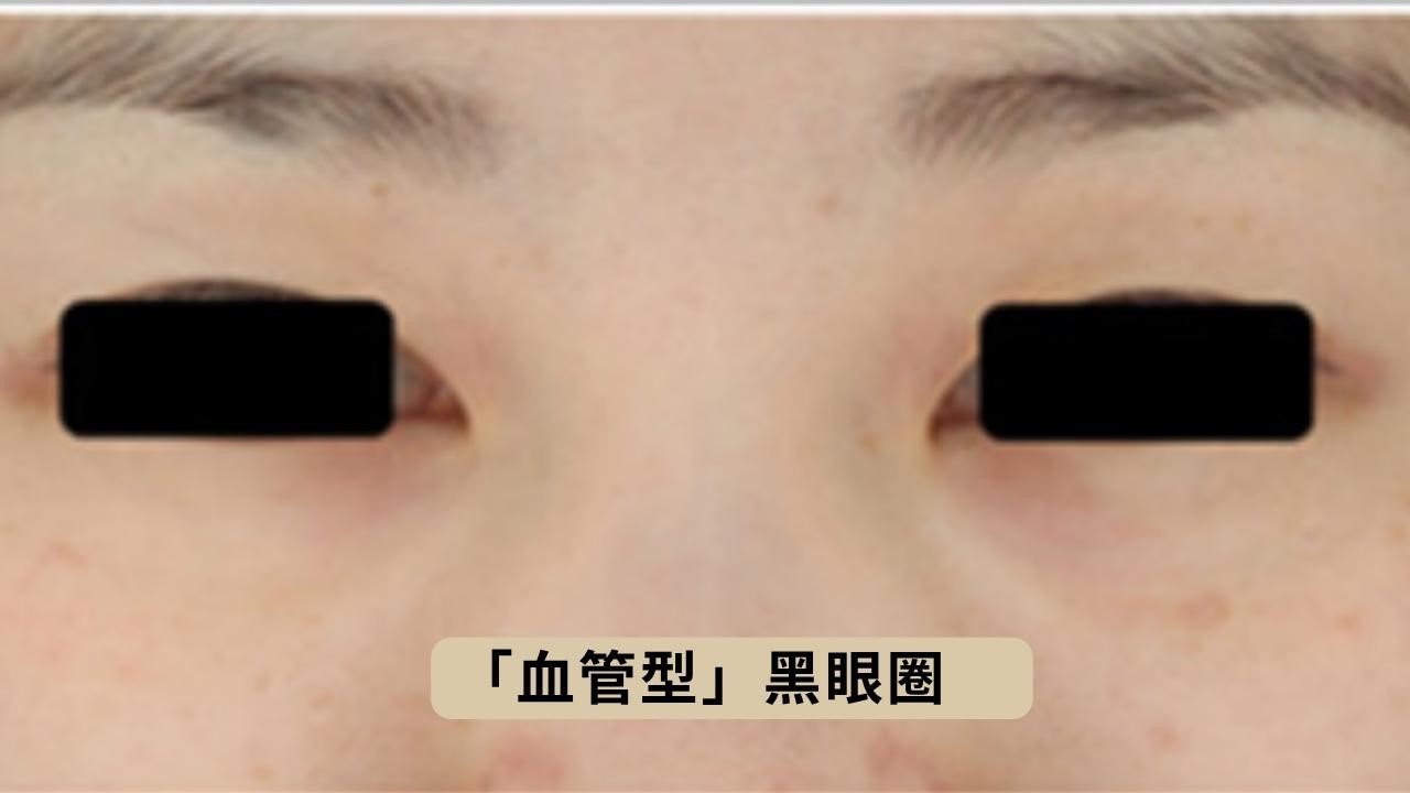 咖啡因眼霜對黑眼圈有效嗎？5種黑眼圈類型眼霜選購指南