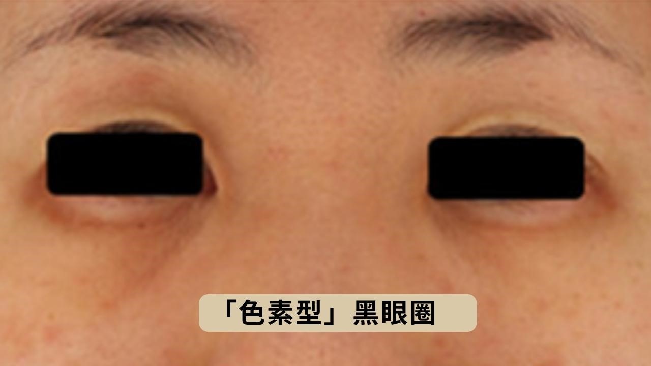 咖啡因眼霜對黑眼圈有效嗎？5種黑眼圈類型眼霜選購指南