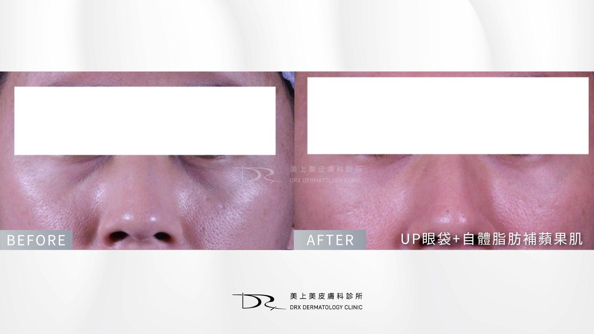 咖啡因眼霜對黑眼圈有效嗎？5種黑眼圈類型眼霜選購指南
