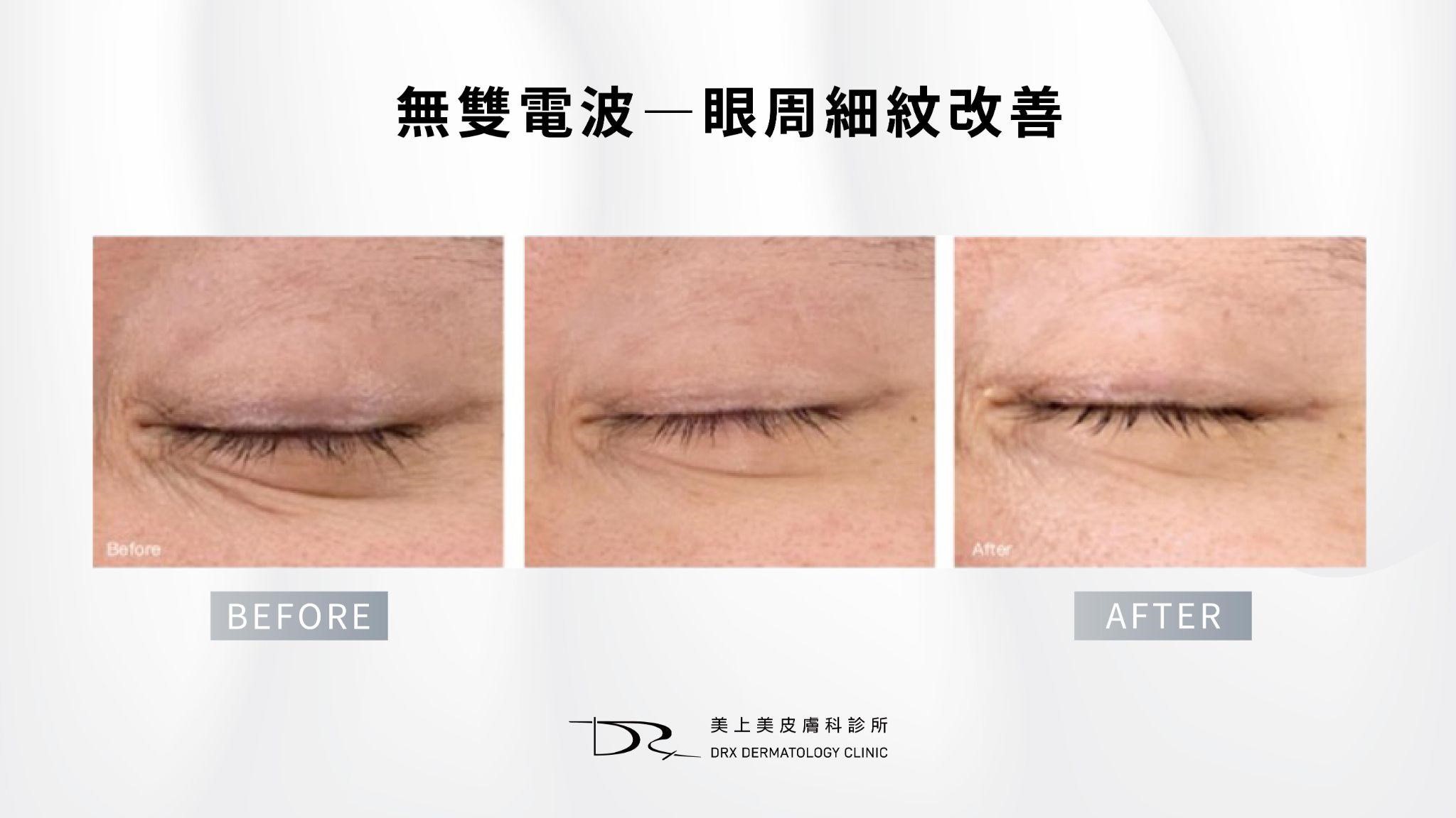 咖啡因眼霜對黑眼圈有效嗎？5種黑眼圈類型眼霜選購指南