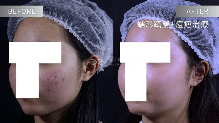 酒糟肌要擦什麼藥膏？益膚康與舒利達的差異？