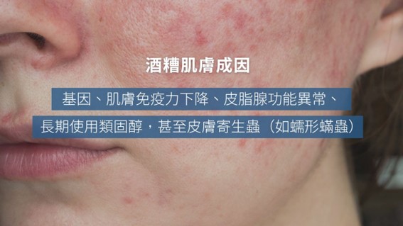 酒糟肌要擦什麼藥膏？益膚康與舒利達的差異？
