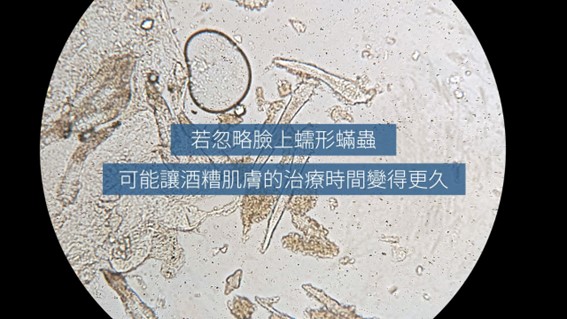 酒糟肌要擦什麼藥膏？益膚康與舒利達的差異？