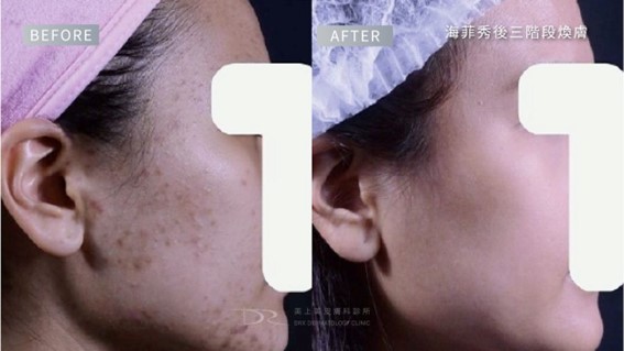 酒糟肌要擦什麼藥膏？益膚康與舒利達的差異？