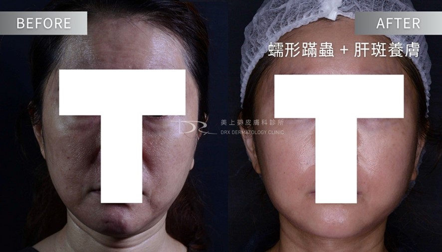 酒糟肌要擦什麼藥膏？益膚康與舒利達的差異？