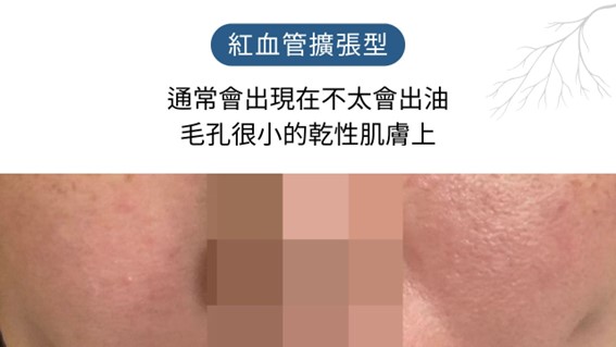 酒糟肌要擦什麼藥膏？益膚康與舒利達的差異？