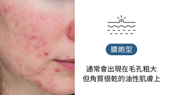 酒糟肌要擦什麼藥膏？益膚康與舒利達的差異？