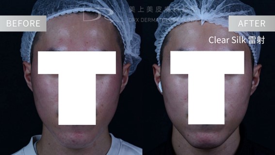 酒糟肌要擦什麼藥膏？益膚康與舒利達的差異？