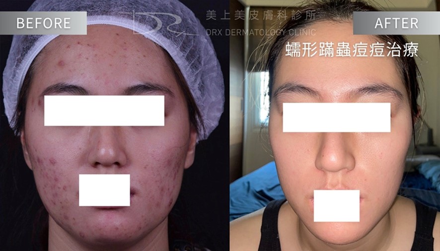 酒糟肌要擦什麼藥膏？益膚康與舒利達的差異？