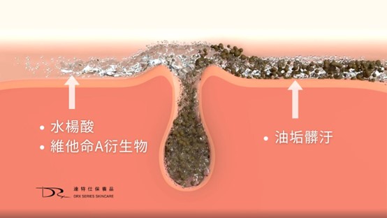 想用A醇改善粉刺、青春痘卻又怕副作用？ 一篇搞懂A醇功效和A醇使用方法！