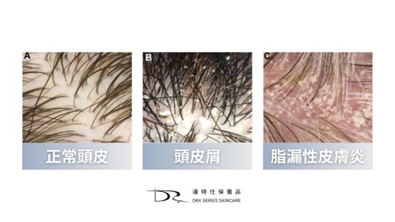 頭皮屑多到大雪紛飛？怎麼改善頭皮屑？