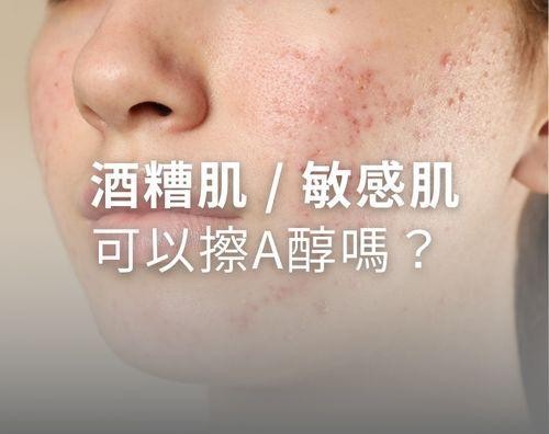 酒糟肌可以擦A醇嗎？敏感肌可以用A醇嗎？