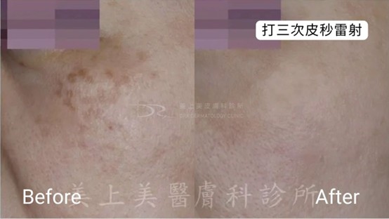 不擦防曬會怎樣？防曬乳、防曬噴霧有差嗎？