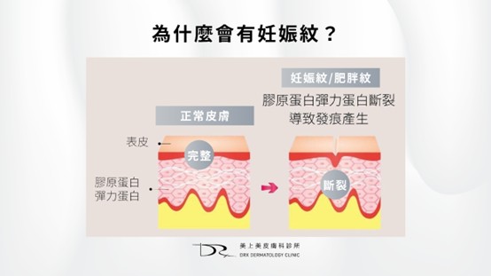 懷孕長痘痘可以擦什麼？妊娠紋要擦什麼？