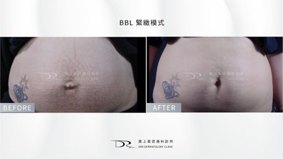 懷孕長痘痘可以擦什麼？妊娠紋要擦什麼？