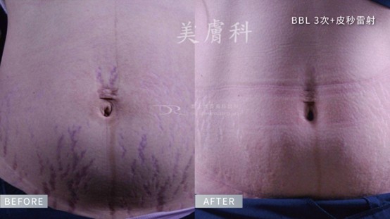 懷孕長痘痘可以擦什麼？妊娠紋要擦什麼？