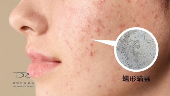 擦A醇會出油嗎？每周固定用A醇和杏仁酸，還需要用磨砂膏去角質嗎？