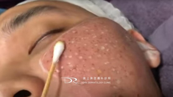 雷射後可以洗臉嗎？雷射術後保養推薦！