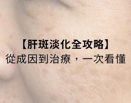 肝斑是許多人常見的臉部色素沉著，特別容易出現在兩頰、額頭與上唇，讓膚色顯得不均勻、暗沉老態。這篇文章一次看懂肝斑治療！