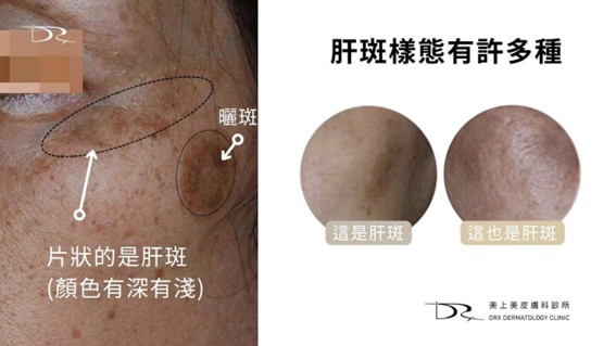 肝斑是許多人常見的臉部色素沉著，特別容易出現在兩頰、額頭與上唇，讓膚色顯得不均勻、暗沉老態。這篇文章一次看懂肝斑治療！