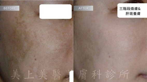 肝斑是許多人常見的臉部色素沉著，特別容易出現在兩頰、額頭與上唇，讓膚色顯得不均勻、暗沉老態。這篇文章一次看懂肝斑治療！