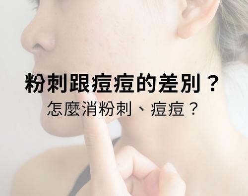 粉刺跟痘痘的差別？粉刺痘痘怎麼消？