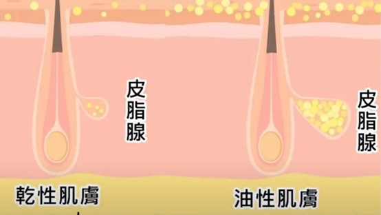 粉刺跟痘痘的差別？粉刺痘痘怎麼消？
