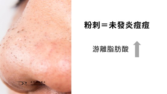 粉刺跟痘痘的差別？粉刺痘痘怎麼消？