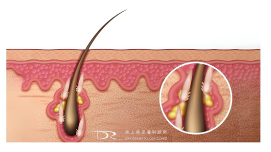 蠕形蟎蟲會傳染嗎？舒利達可以早晚擦嗎？