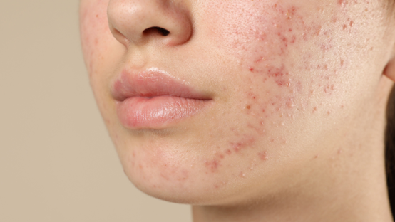 蠕形蟎蟲會傳染嗎？舒利達可以早晚擦嗎？