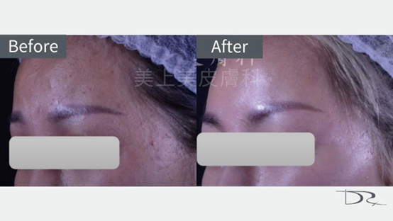 蠕形蟎蟲會傳染嗎？舒利達可以早晚擦嗎？