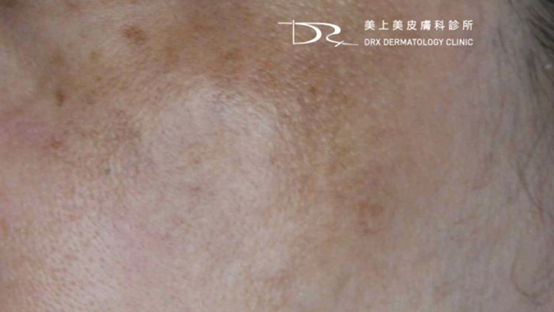 斑越打越多？臉上的斑如何去除？