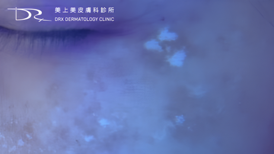斑越打越多？臉上的斑如何去除？