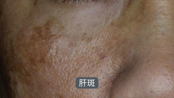 斑越打越多？臉上的斑如何去除？