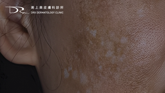 斑越打越多？臉上的斑如何去除？