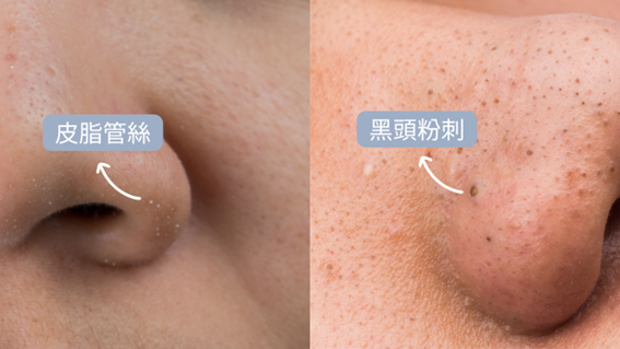 很多人照鏡子時，會發現鼻子靠近毛孔的位置有一粒一粒白白的東西，常被誤以為是粉刺或痘痘，其實，這很可能是皮脂管絲——皮脂腺分泌油脂時，混合角質和細菌在毛孔口形成的自然現象！