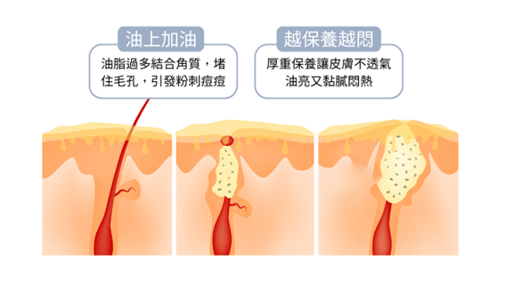 現代很多網紅都在說：你會出油，就是因為缺油！所以要用油來保養。聽起來很有道理，畢竟以油制油這個概念很吸睛，但油性肌真的適合用油保養嗎？