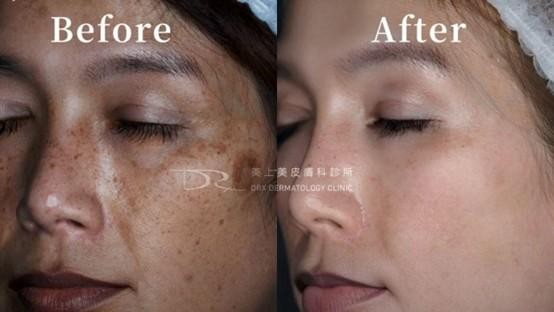 無論是改善青春痘、美白淡斑,保養品擦多久才有效果? 無論是改善青春痘、美白淡斑,保養品擦多久才有效果?