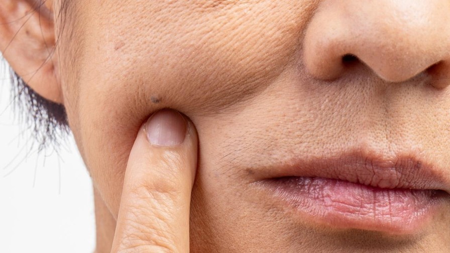 痘膚潤 Differin Gel 的主要成分是 adapalene（阿達帕林），屬於 第三代 A 酸。痘膚潤是少數可在藥局直接購買的 A 酸藥膏。很多人都疑惑痘膚潤的正確用法是什麼? 要如何與其它抗痘保養品搭配，還有順序要怎麼擦呢？