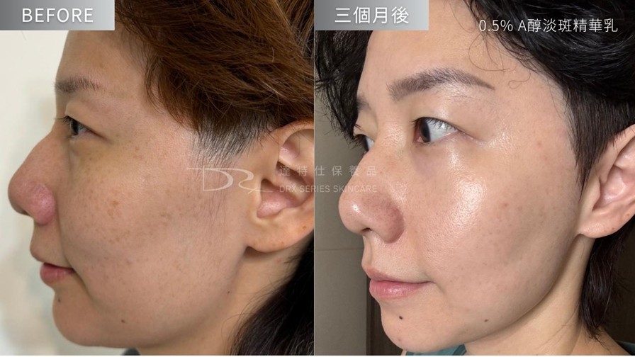 A醇有淡斑效果嗎？媽媽淡斑推薦保養步驟！