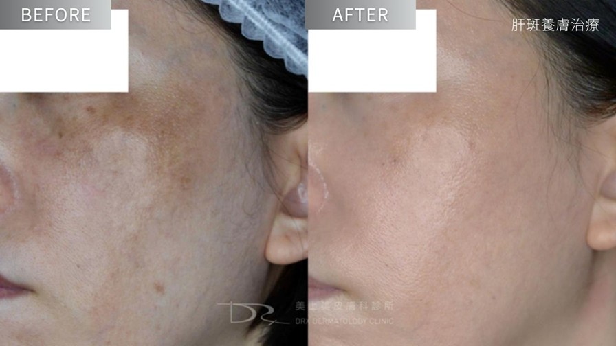 A醇有淡斑效果嗎？媽媽淡斑推薦保養步驟！