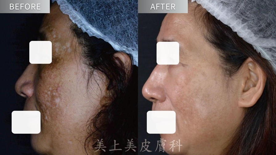 A醇有淡斑效果嗎？媽媽淡斑推薦保養步驟！