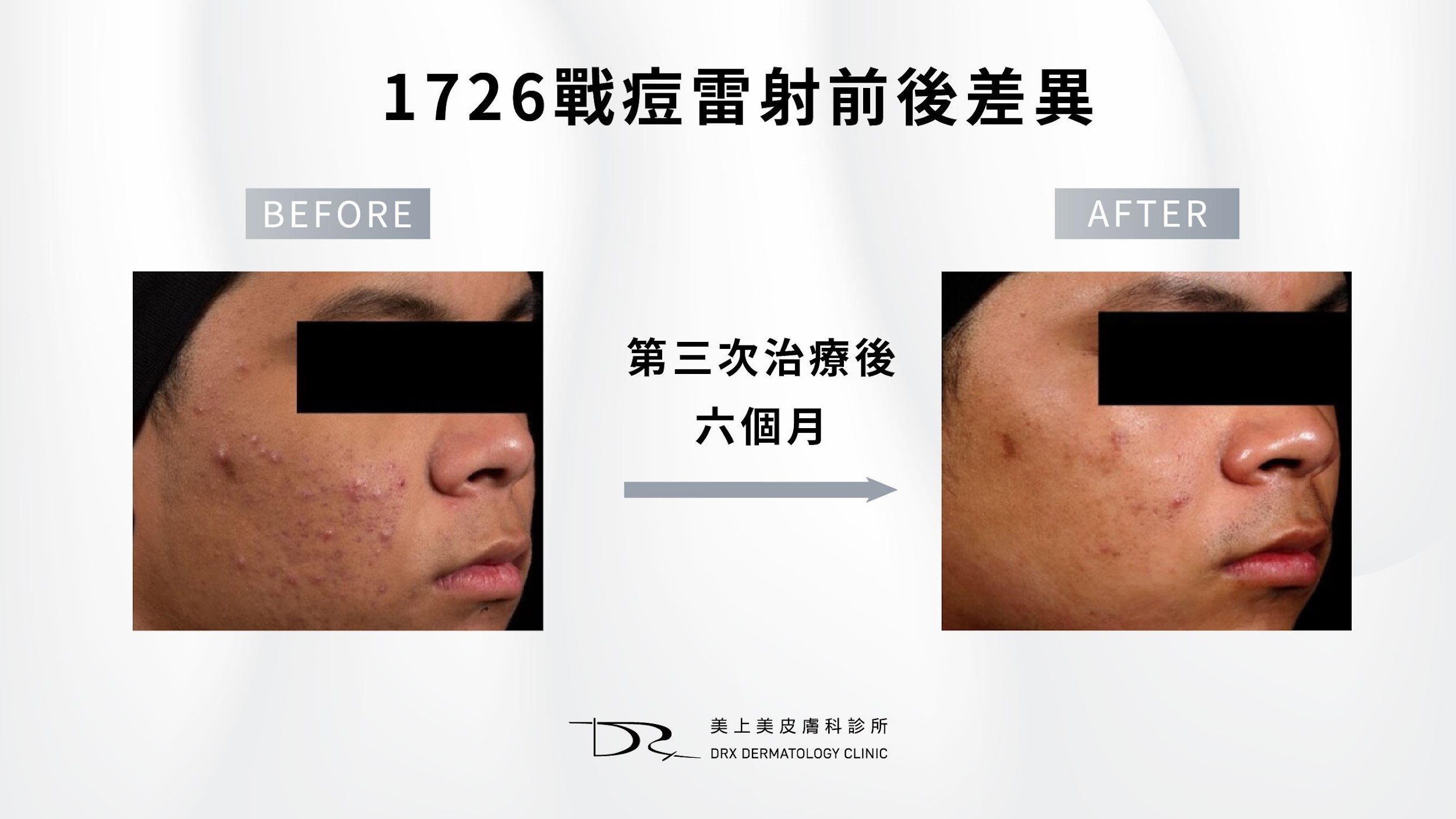 青春期如何讓皮膚變好?適合青春期的保養品! 青春期如何讓皮膚變好?適合青春期的保養品!