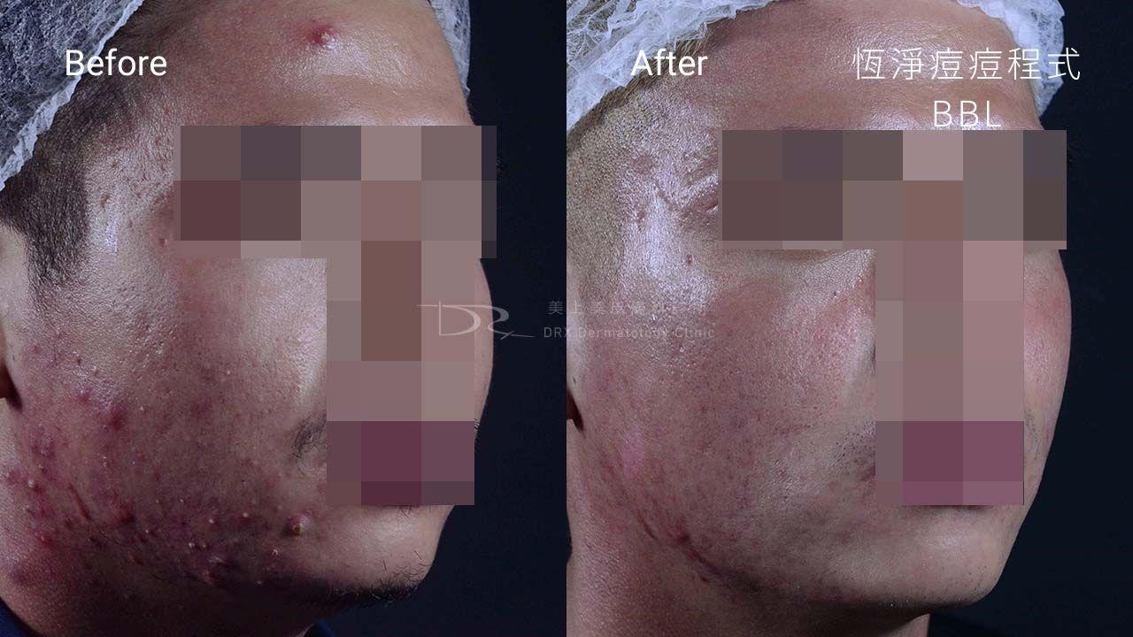 青春期如何讓皮膚變好?適合青春期的保養品! 青春期如何讓皮膚變好?適合青春期的保養品!