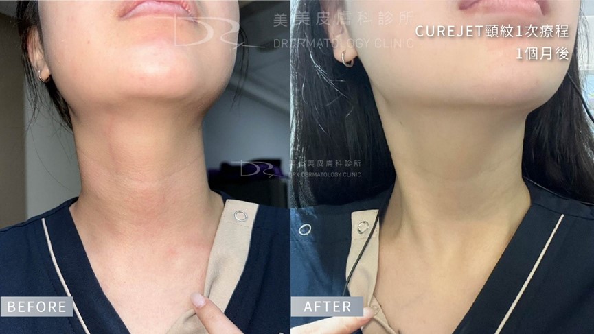 脖子美白?頸紋霜有用嗎?如何選擇適合的頸部保養成分? 脖子美白?頸紋霜有用嗎?如何選擇適合的頸部保養成分?